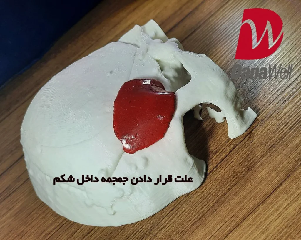 علت قرار دادن ججمه داخل شکم